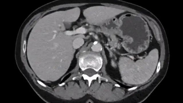 Laparoscopic Radical Left Pancreatectomy for Pancreatic Cancer: Surgical Strategy and Technique Video