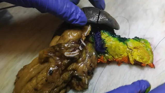 DIPLOMA Approach for Standardized Pathology Assessment of Distal Pancreatectomy Specimens