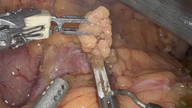 Robot Assisted Distal Pancreatectomy with Celiac Axis Resection (DP-CAR) for Pancreatic Cancer: Surgical Planning and Technique