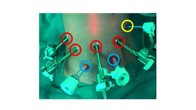 Robotic D3 Partial Duodenal Resection with Primary Side-to-Side Anastomosis