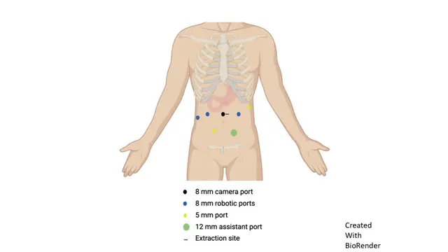 Resección robótica de manga duodenal para tumor estromal gastrointestinal con mutación rara del exón 8 KIT tras el neoadyuvante imatinib