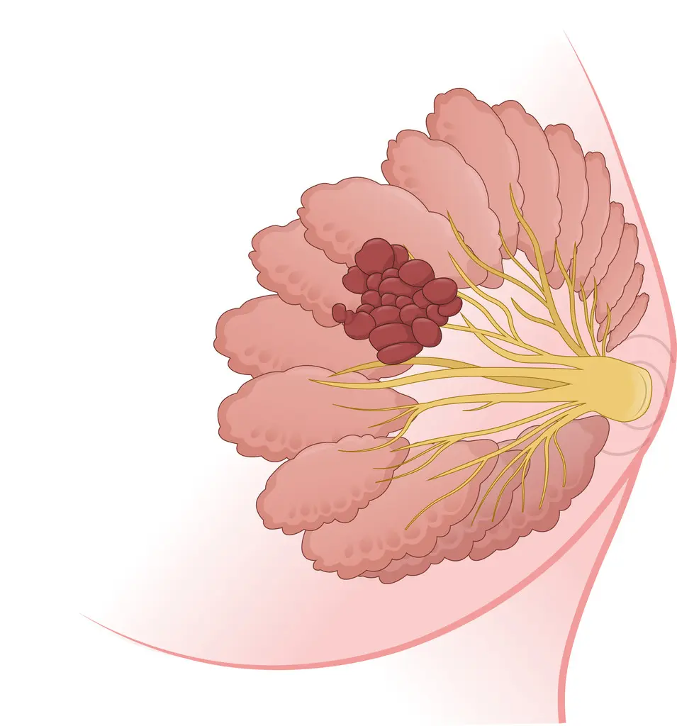 Breast Cancer