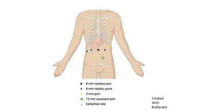 Resección robótica de manga duodenal para tumor estromal gastrointestinal con mutación rara del exón 8 KIT tras el neoadyuvante imatinib