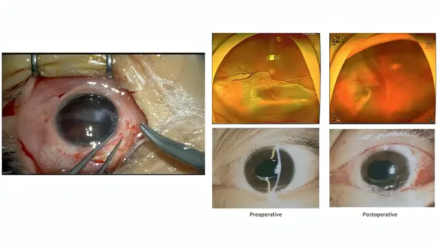 Protocolo de implantación del cuerpo vítreo capsular plegable para cirugía vítreoretiniana compleja