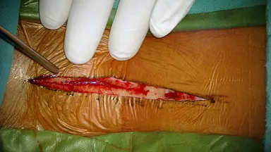 Duroplastia de expansión para una inflamación severa de la médula espinal cervical tras una lesión traumática: un protocolo quirúrgico paso a paso