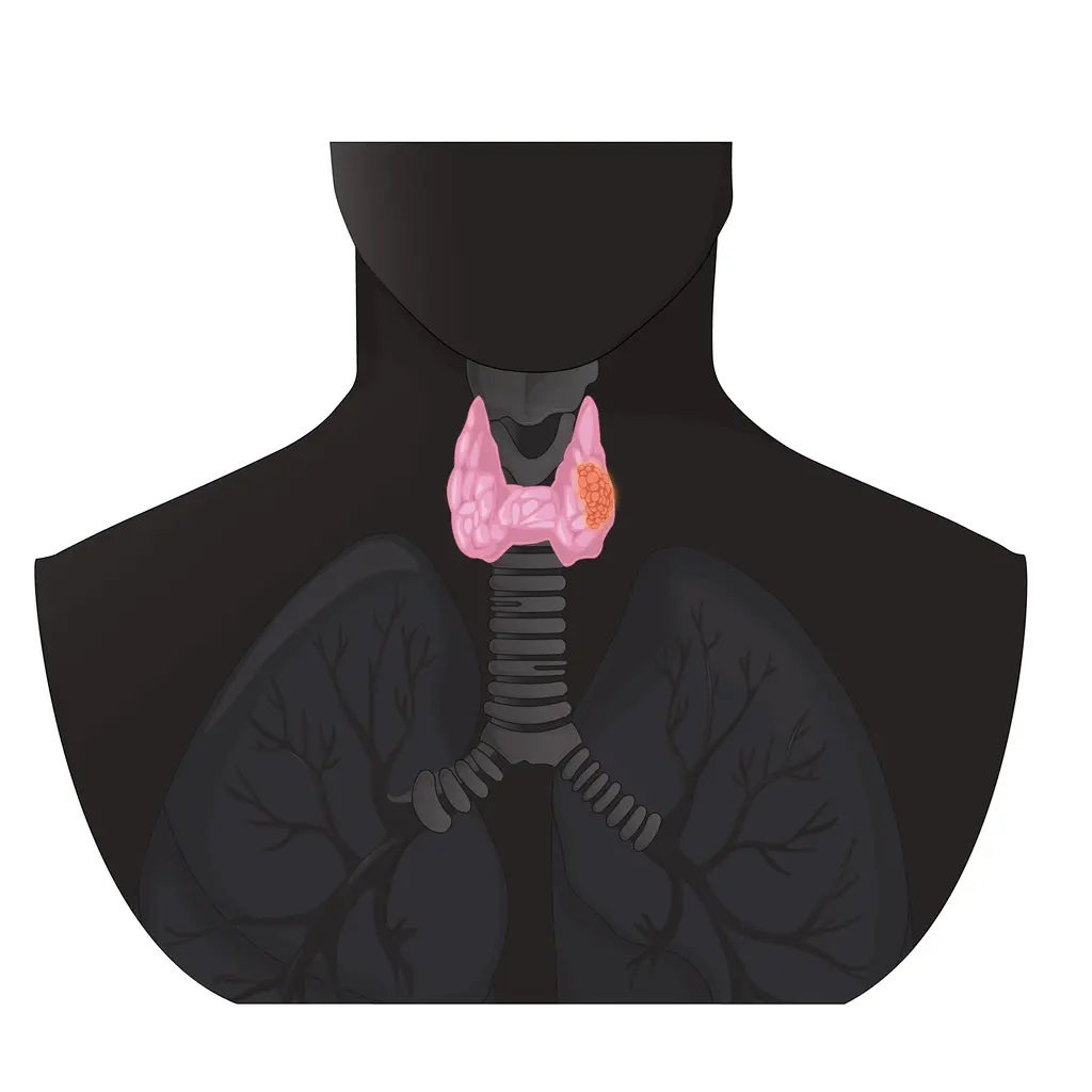 Head and Neck Cancer