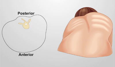 Human anatomy diagram of scapula orientation; anterior and posterior views comparison.