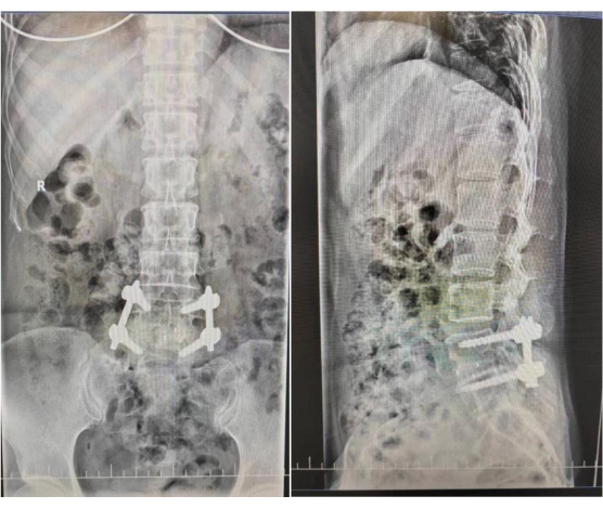 Spinal fusion X-rays; frontal and lateral views showing metal implants, vertebral alignment.