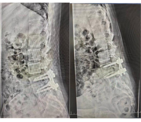 Spinal fusion X-ray; vertebrae stabilization with screws and rods; postoperative recovery analysis.