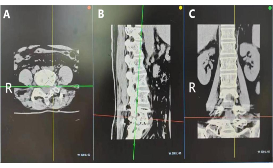 MRI spinal scan, sagittal, axial, coronal views; vertebral column assessment, radiological analysis.