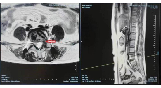 Spinal MRI scans; axial and sagittal views showing disc herniation; medical imaging analysis.